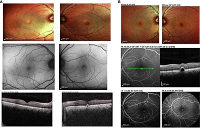 Case Report: Spectrum of interesting ocular manifestations following COVID-19 vaccination: a case series of real-world presentations